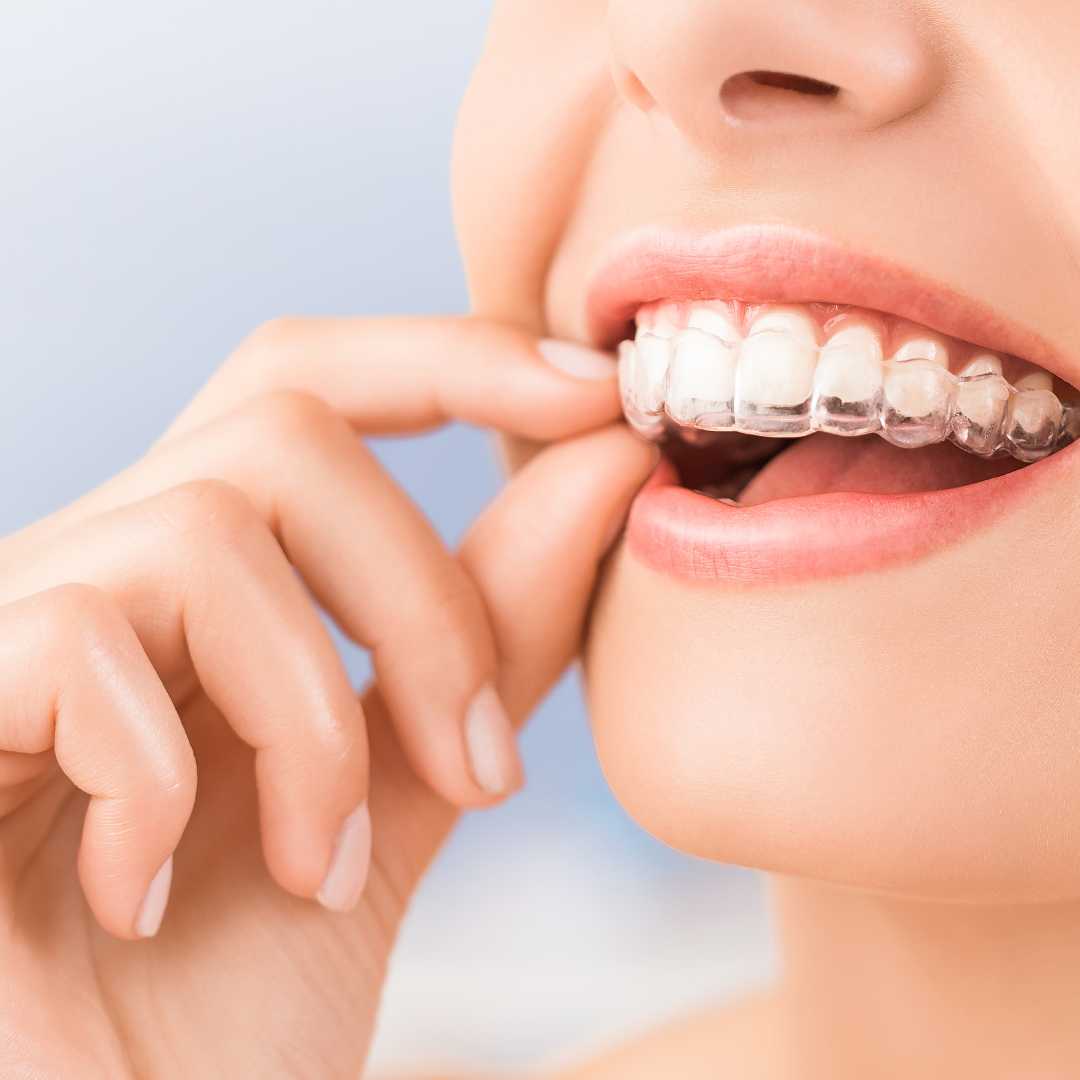 Unlocking Your Best Smile In Calgary NE The Incredible Benefits Of Invisalign